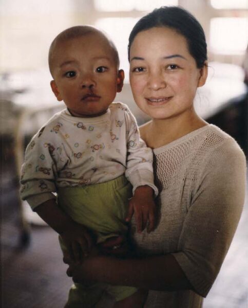 Mother and child with cleft lip in Ethiopia. Patient of Dr. Wayne Larrabee. 